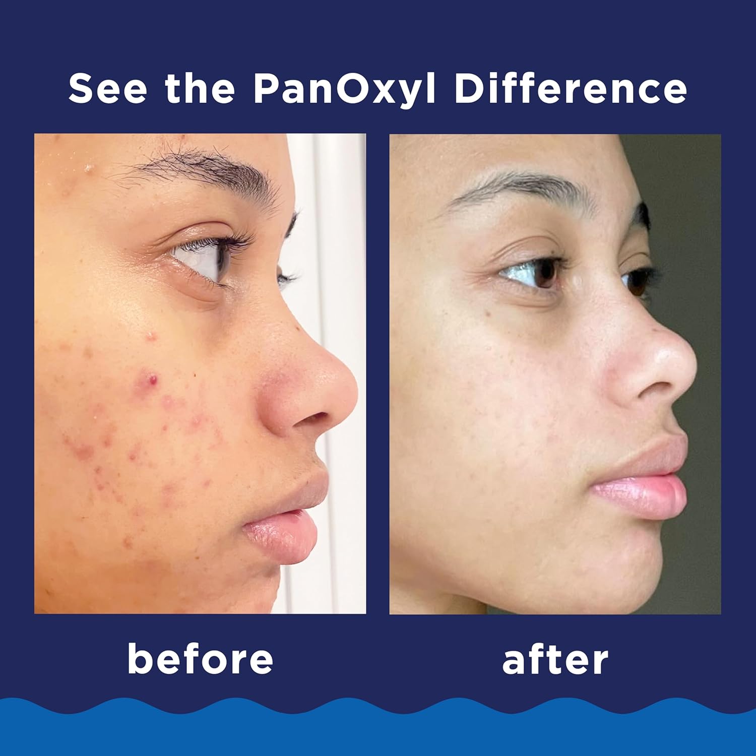 Panoxyl Putojantis prausiklis nuo spuogų, 10 % stiprumo benzoilo peroksidas, antimikrobinis